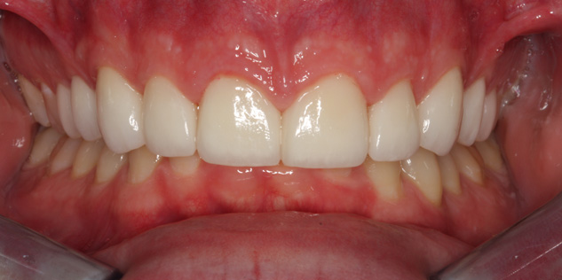 SmileGallery_Joe_Teeth_After