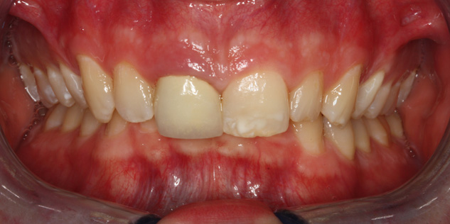 SmileGallery_Joe_Teeth_Before