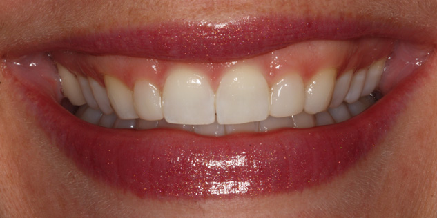SmileGallery_Lachelle_Smile_After
