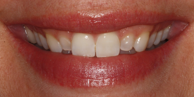 SmileGallery_Lachelle_Smile_Before