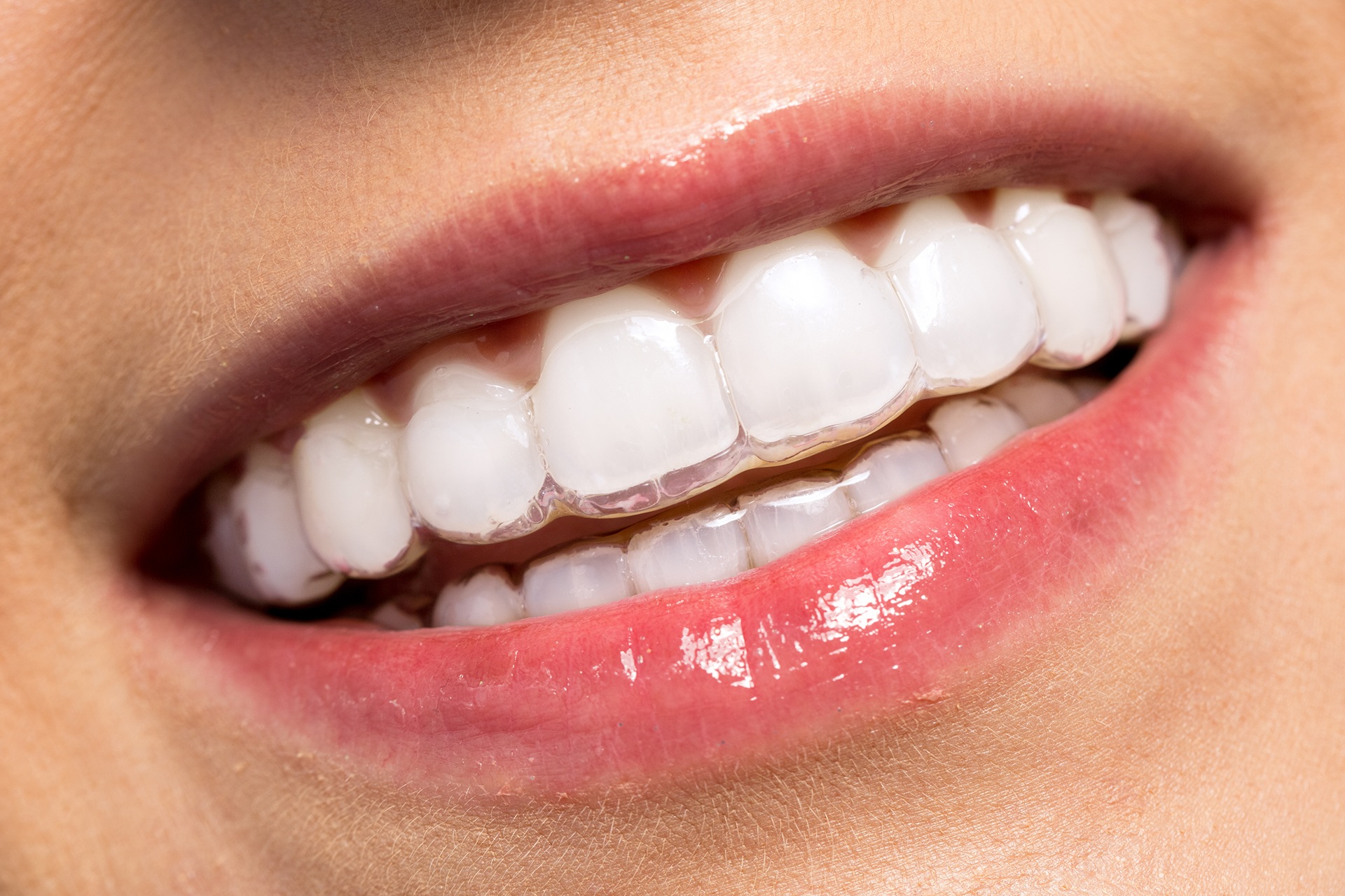 Invisalign At Oakville Dental Care Cosmetic Services