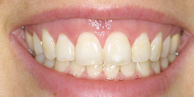 Gum Contouring at Oakville Dental Care | Cosmetic Services