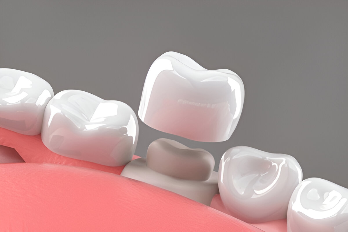 CEREC Crown Appointment