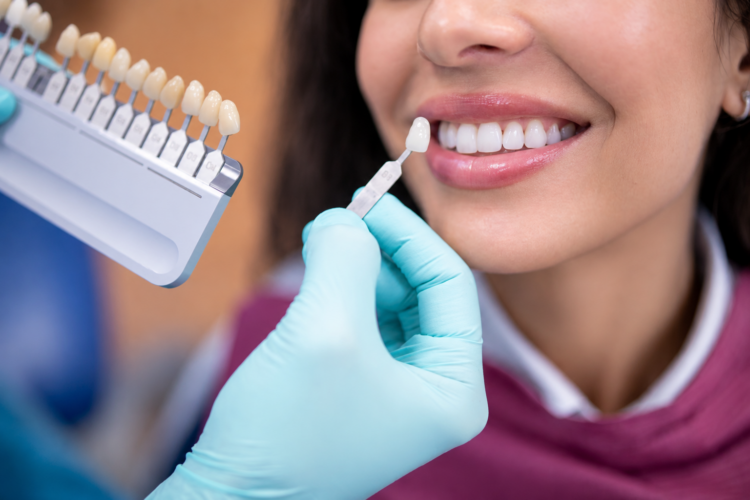 how long do veneers last